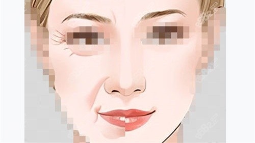 拉皮手術(shù)前后對比示意圖