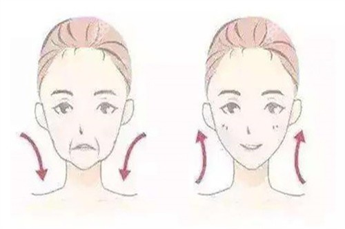 拉皮面部提升對比卡通示意圖