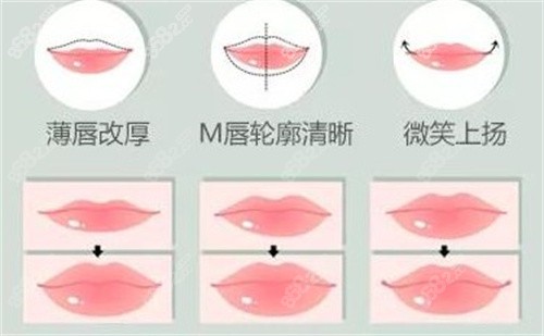 嘴唇整形手術(shù)