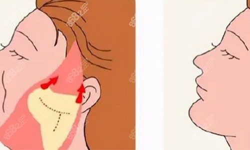 拉皮手術(shù)的術(shù)后對比圖