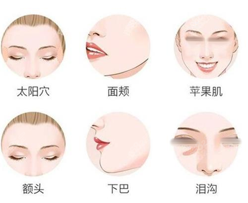 面部填充部位一覽圖
