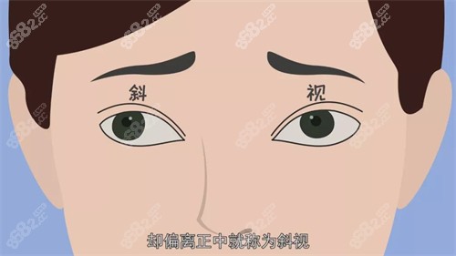 斜視動畫示意圖