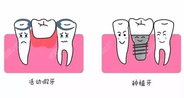 宁波美莱口腔做种植牙的技术好不好