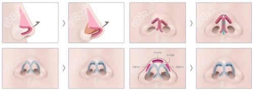 鼻修復示意圖
