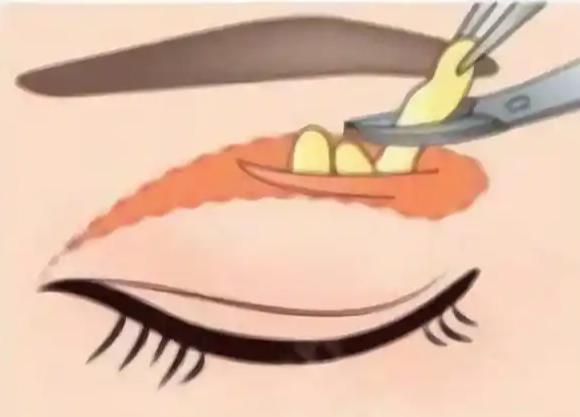 三、雙眼皮形態(tài)調(diào)整：賀潔如何打造精致媽生感？