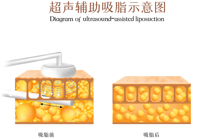 三、 杭州彭濤吸脂價(jià)格：明碼標(biāo)價(jià)，花錢花在刀刃上
