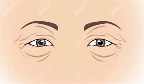 衰老的雙眼皮