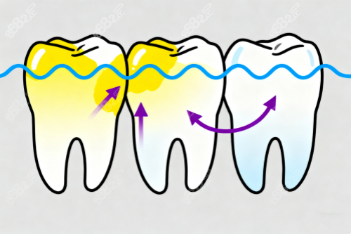 牙齒美白變化圖 牙齒美白變化圖