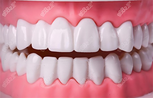 牙齒美白模型 牙齒美白模型