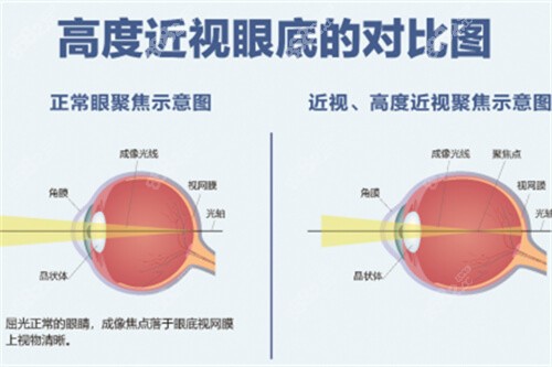 高度近視眼底的對比圖 高度近視眼底的對比圖
