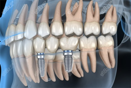 種牙圖示 種牙圖示