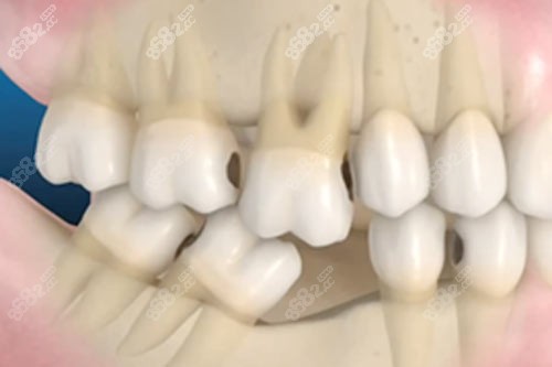 牙齒缺一顆不補(bǔ)產(chǎn)生的影響圖 牙齒缺一顆不補(bǔ)產(chǎn)生的影響圖