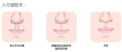 人中縮短術 人中縮短術