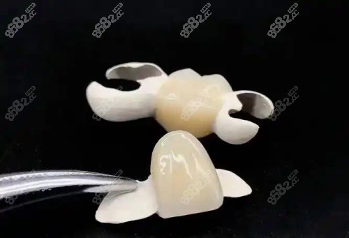 hpp粘接橋牙齒示意圖 hpp粘接橋牙齒示意圖