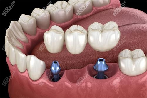 多顆種植牙圖片 多顆種植牙圖片