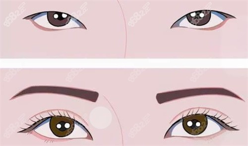 雙眼皮前后對(duì)比
