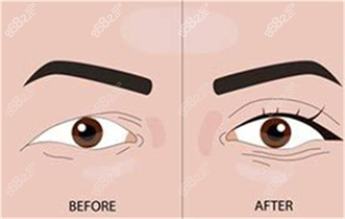 雙眼皮手術(shù)前后對(duì)比