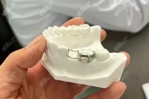 兒童牙齒間隙保持器 兒童牙齒間隙保持器