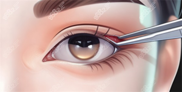 割雙眼皮過程