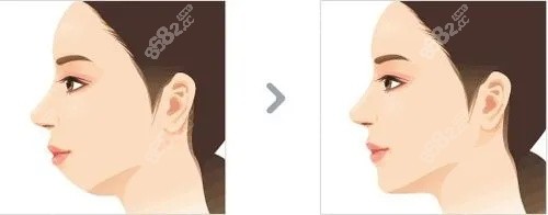 下巴整形對比圖