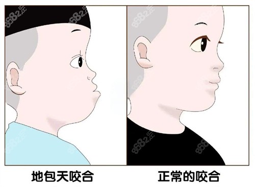 地包天和正常對比圖