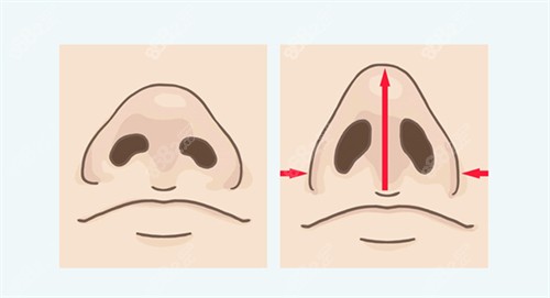 鼻翼縮小鼻子挺拔