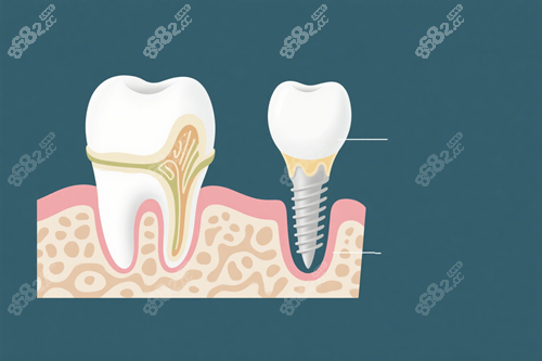 種植牙示意圖 (1)