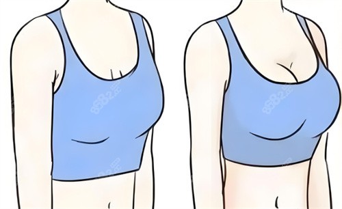 隆胸前后對(duì)比