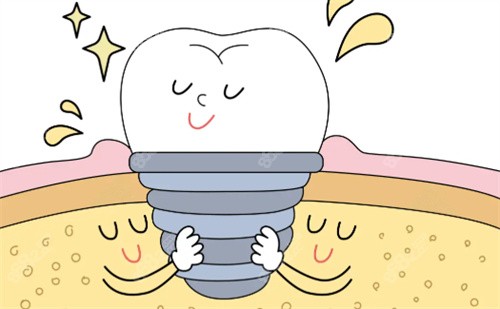 種植牙卡通展示圖片