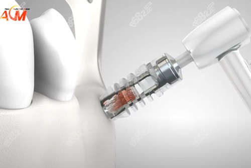 德國ACM種植牙示意圖