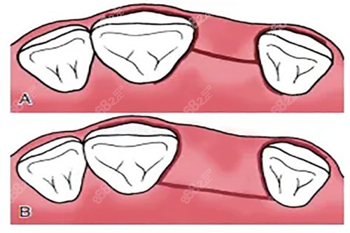 傳統(tǒng)翻瓣種植牙切口卡通示意圖