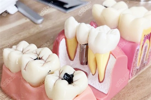 合肥靚美口腔醫(yī)院種植牙模型