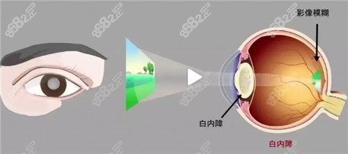 白內(nèi)障視力表現(xiàn)圖