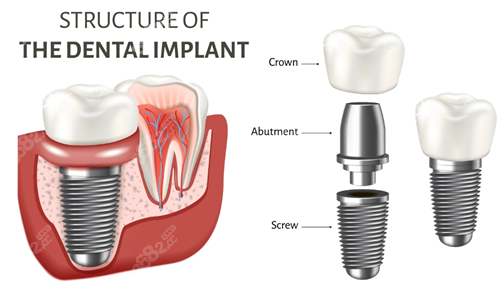 種植牙組件示意圖