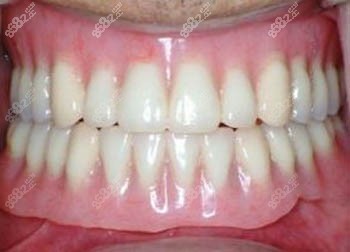 假牙照片