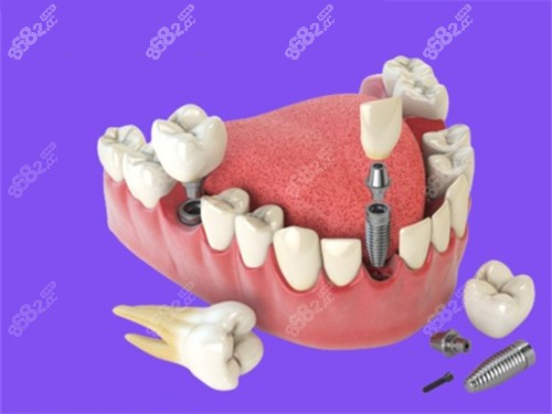 多顆種植牙漫畫圖