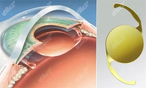 白內(nèi)障人工晶體的選擇