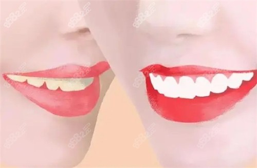 牙齒美白前后對比圖