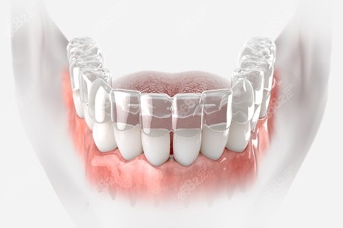 隱適美矯治器模型示意圖