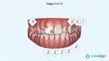 隱適美病例設(shè)計(jì)
