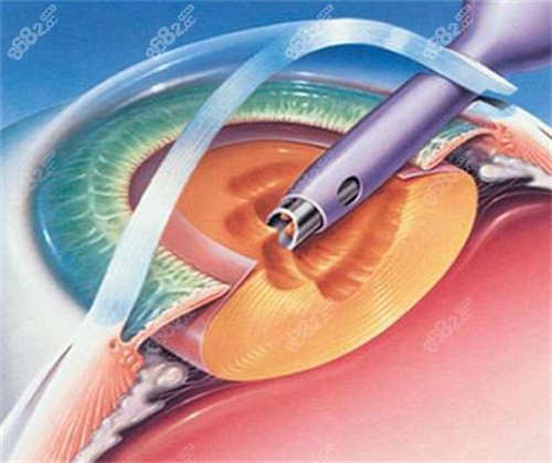 白內(nèi)障囊外摘除術(shù)圖片