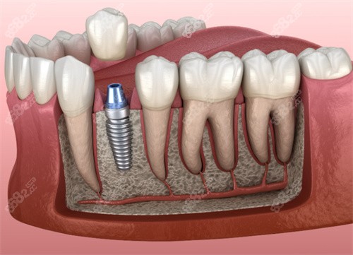 種植牙解剖模型