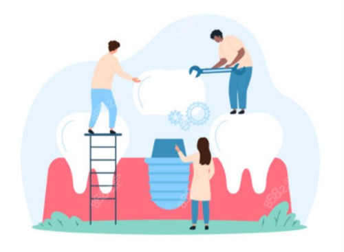 種植牙卡通示意