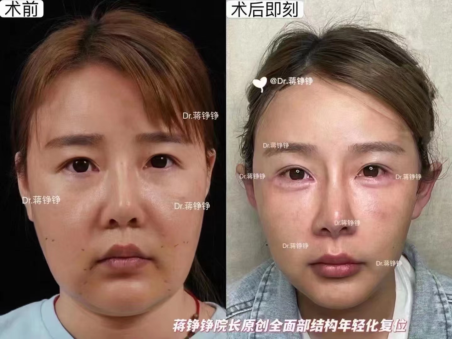 金洪堯個(gè)人簡歷揭秘：近20年脂肪領(lǐng)域經(jīng)驗(yàn)，適合人群與面診建議