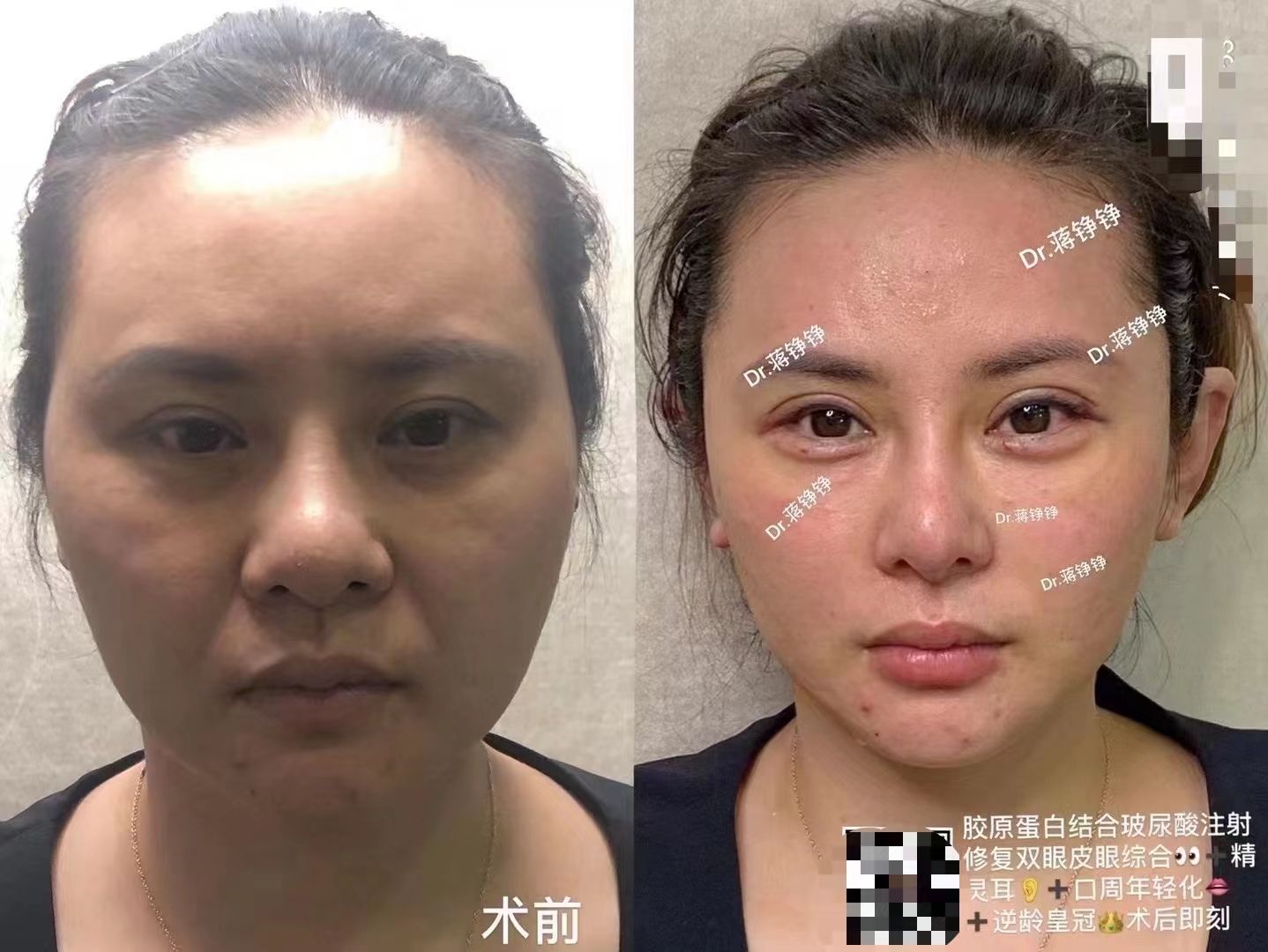 金洪堯個(gè)人簡歷揭秘：近20年脂肪領(lǐng)域經(jīng)驗(yàn)，價(jià)格與詢問說明