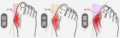拇外翻大腳骨程度