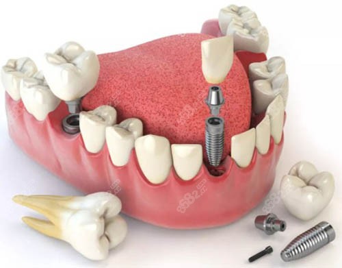 昭通西南博大口腔2026價(jià)格表，種牙2500起、牙齒矯正7390起
