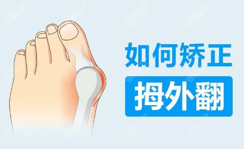 如何矯正拇外翻