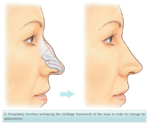 假體隆鼻