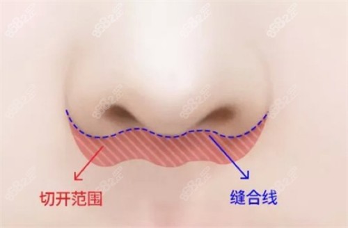 埋線人中縮短術(shù)手術(shù)位置圖解